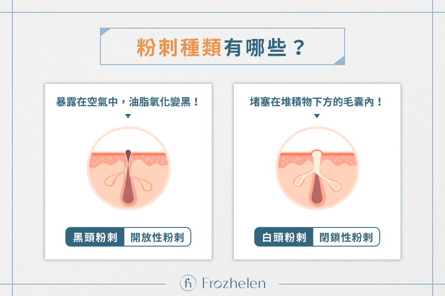 粉刺種類有哪些？